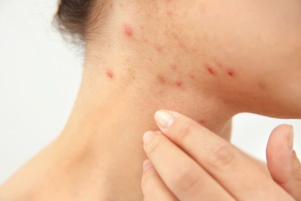 How to Treat Hormonal Acne and Stop Breakouts in Their Tracks